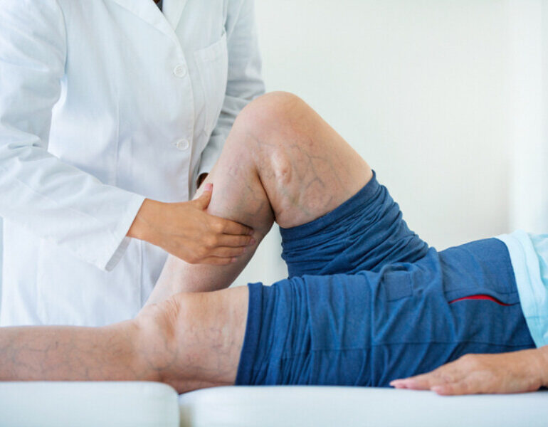 Varicose Vein Treatment